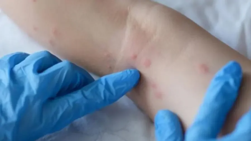 Mpox