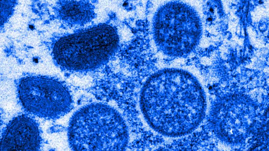 OMS : La variole du singe n’est pas une urgence sanitaire mondiale La variole du singe