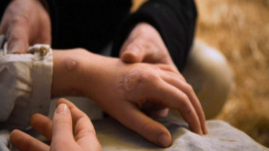 Variole du singe: Un premier cas d'infection confirmé en France Variole du singe